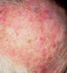 Image result for Actinic Keratosis On Forehead