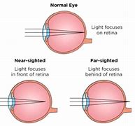 Image result for Myopia Drawing
