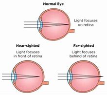 Image result for Astigmatism vs Myopia