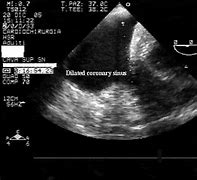Image result for Dilated Coronary Sinus