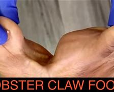 Image result for Lobster Claw Deformity