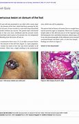 Image result for Verrucous Lesion Foot