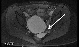 Image result for MRI of Ovarian Dermoid