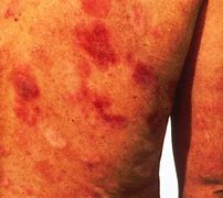 Image result for Kaposi's Sarcoma-Associated HerpesVirus