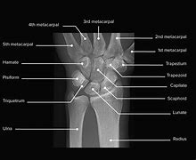 Image result for Accessory Bones Wrist