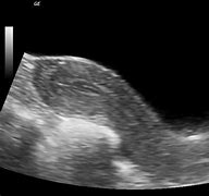 Image result for Dermoid Cyst Uterus