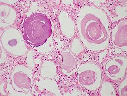 Image result for Collapsed Alveoli