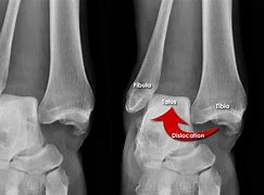 Image result for Broken Dislocated Ankle Female