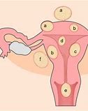 Image result for Fibroids Sizes Compared to Fruit