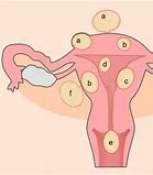 Image result for Anterior Uterine Fibroid