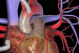 Image result for 5 Artery Bypass Surgery