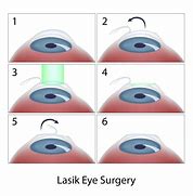 Image result for Laser Refractive Surgery