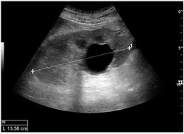 Image result for Simple Renal Cyst Ultrasound
