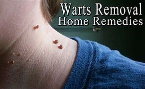 Image result for Face Warts Treatment