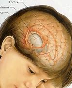 Image result for How Big Is a 2 5 Cm Tumor