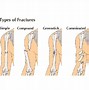 Image result for Resetting a Broken Bone