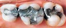 piombatura denti amalgama dentale piombatura denti amalgama dentale