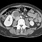 Image result for Gist Tumor of Small Bowel On CT
