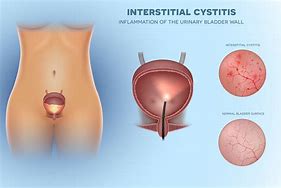 Image result for cystoskopia