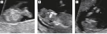 Image result for Anencephaly Ultrasound 12 Weeks