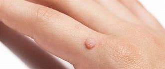 Image result for Common Wart On Palm of Hand