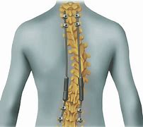 Image result for Spine Hooks