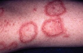Image result for Lupus Skin Rash On Feet