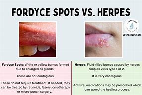 Image result for Genital Warts vs Fordyce Spots