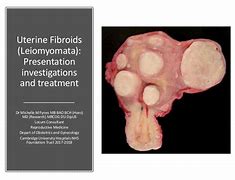 Image result for 3.5 Cm Fibroid Tumor