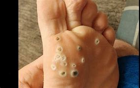 Image result for Water Warts On Foot
