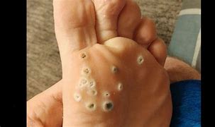 Image result for Seed Wart Foot