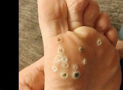 Image result for Seed Wart Removal