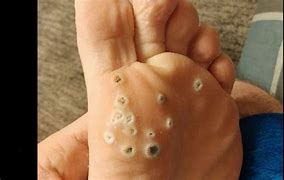 Image result for Plantar Wart Coming Out