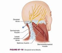 Image result for Occipital Nerve Block