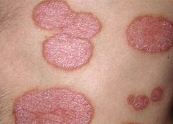 Image result for What Does Plaque Eczema Look Like