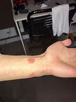 Image result for Apple Watch Burning Wrist