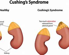 Image result for Nodule On Adrenal Gland