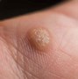 Image result for Warts in Body