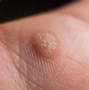 Image result for Wart On Arm