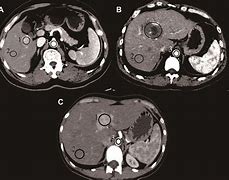 Image result for Liver Cancer MRI