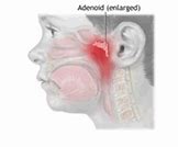 Image result for adenoidee