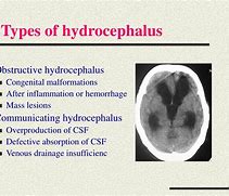 Image result for Different Types of Hydrocephalus