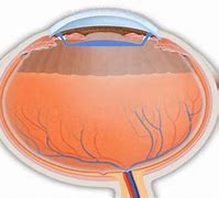 Image result for Posterior Chamber Intraocular Lens