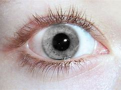 Image result for Most Rare Eye Color Red