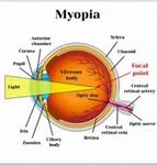 Image result for Myopia Lasik