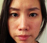Image result for Allergic Reaction to Shampoo On Face