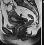 Image result for 3.5 Cm Fibroid Tumor