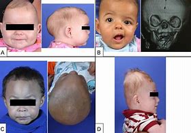 Image result for Craniosynostosis Head Shapes