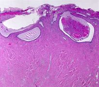 Image result for Nabothian Cyst Histology