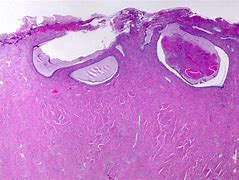 Image result for Cervix Cyst